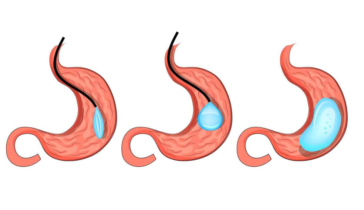 gastric balloon turkey