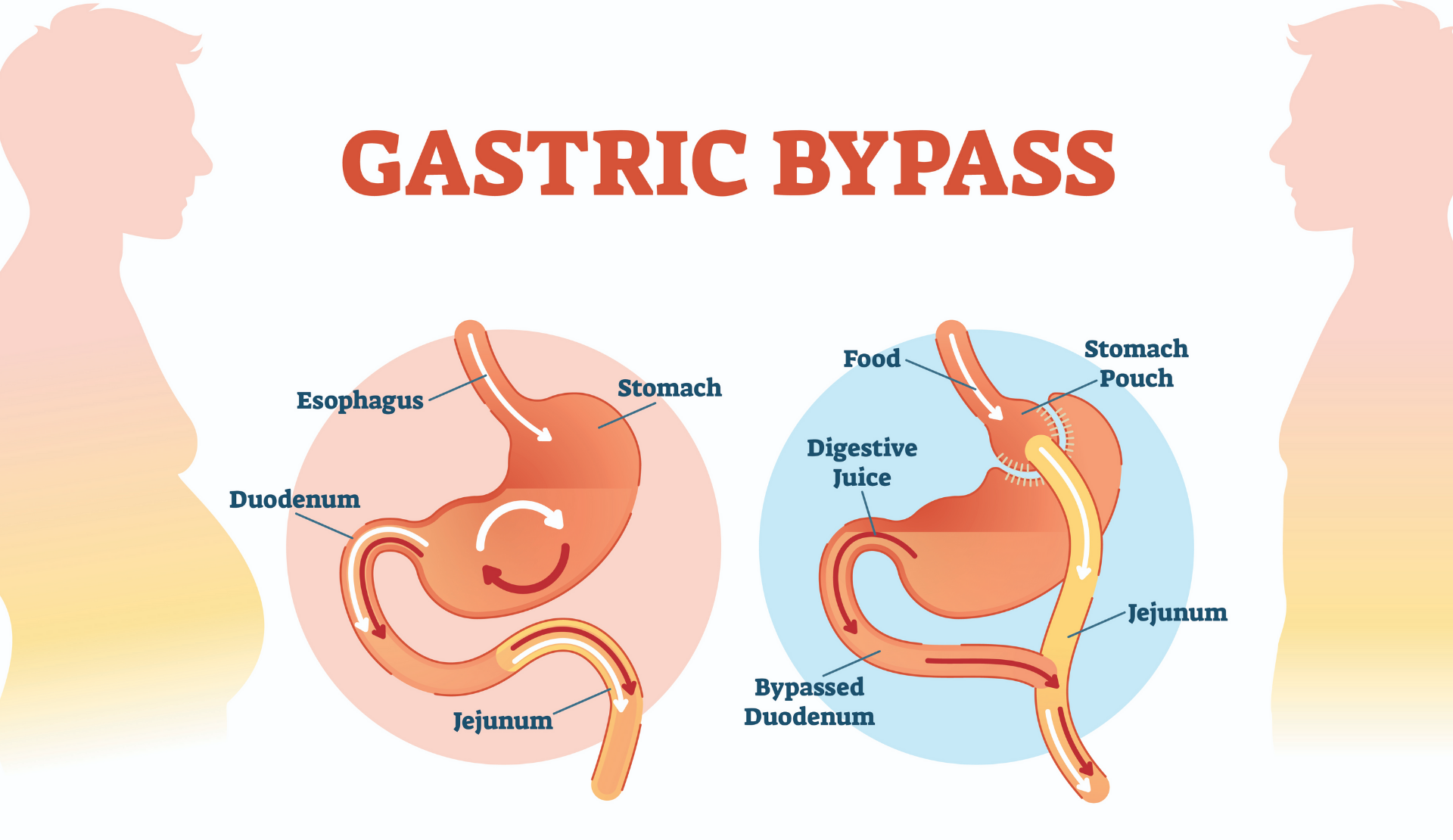 Gastric Bypass Surgery Cost And Reviews In Antalya Turkey Medi Tour Turkei 3942