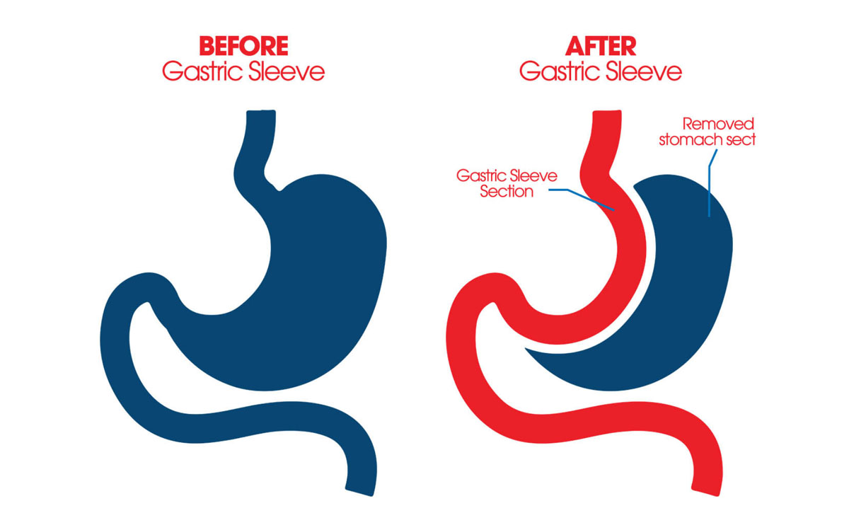 gastric sleeve surgery